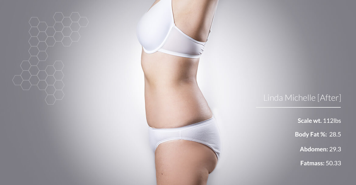 After-شفط الدهون