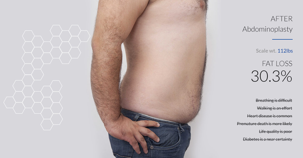 After-شفط الدهون