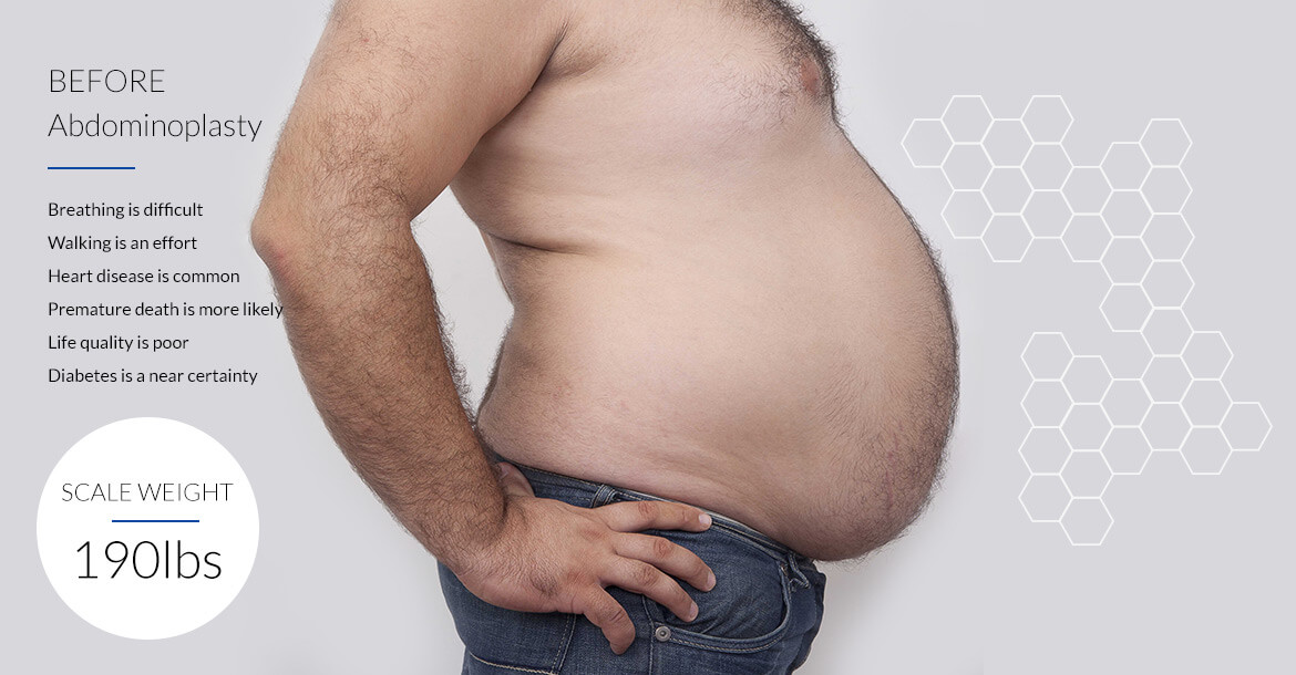 Before-شفط الدهون